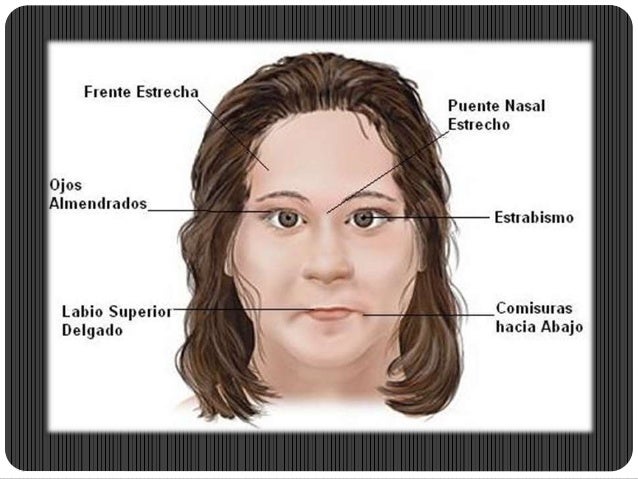sindrome prader willi